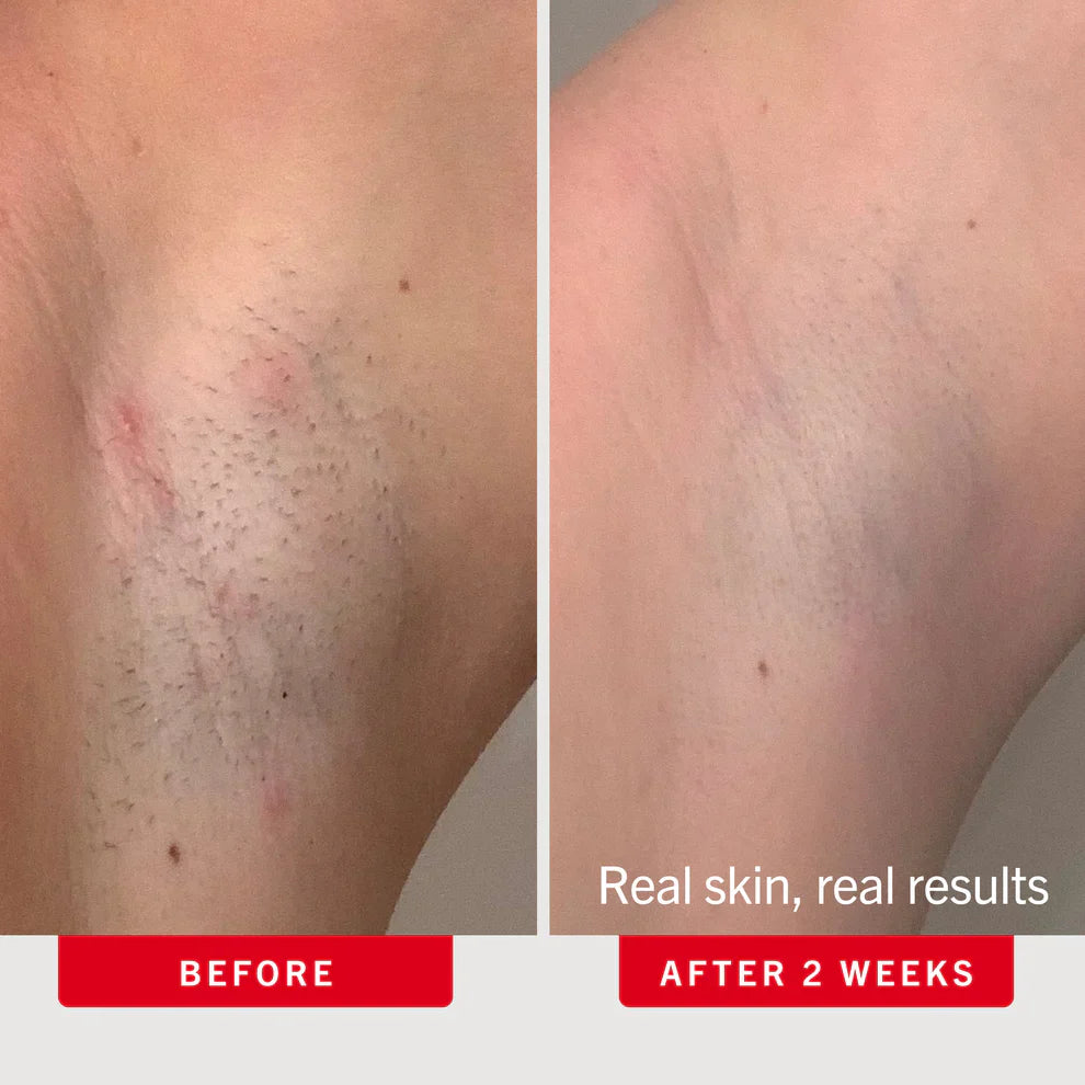 Ingrown Hair Pads with BHA + AHA