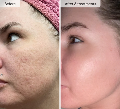 Skinvae™ Micro Infusion Kit