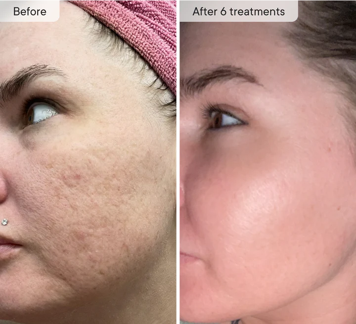 Skinvae Micro Infusion Kit