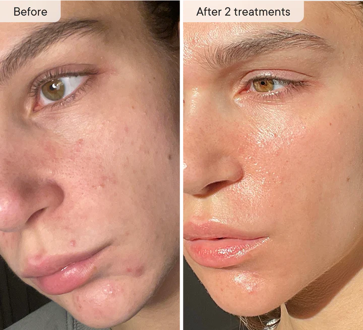 Skinvae Micro Infusion Kit