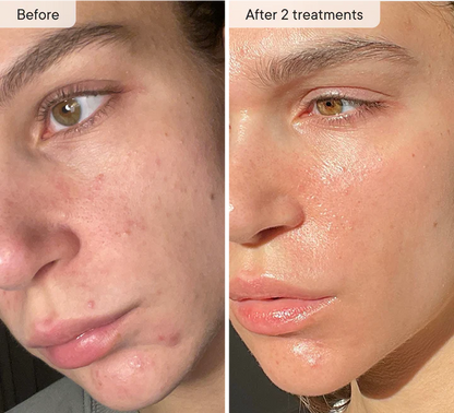 Skinvae Micro Infusion Kit